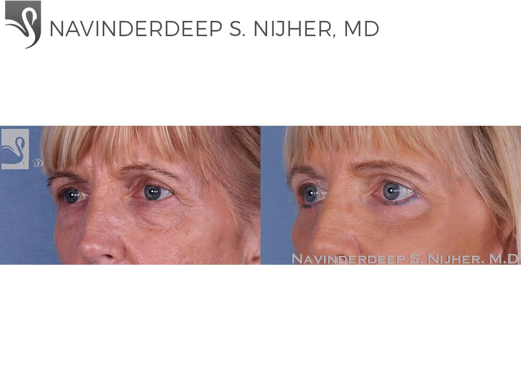 Before and After Image: Eyelid Surgery Case #13051 - left-front-oblique