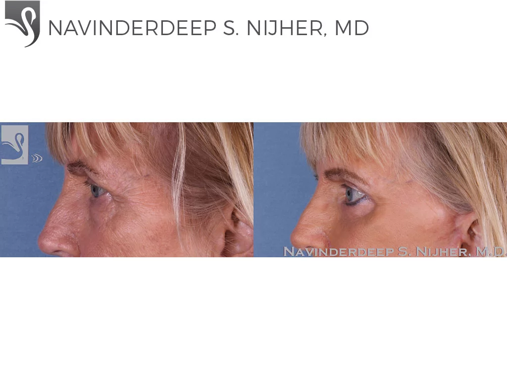 Before and After Image: Eyelid Surgery Case #13051 - left-side