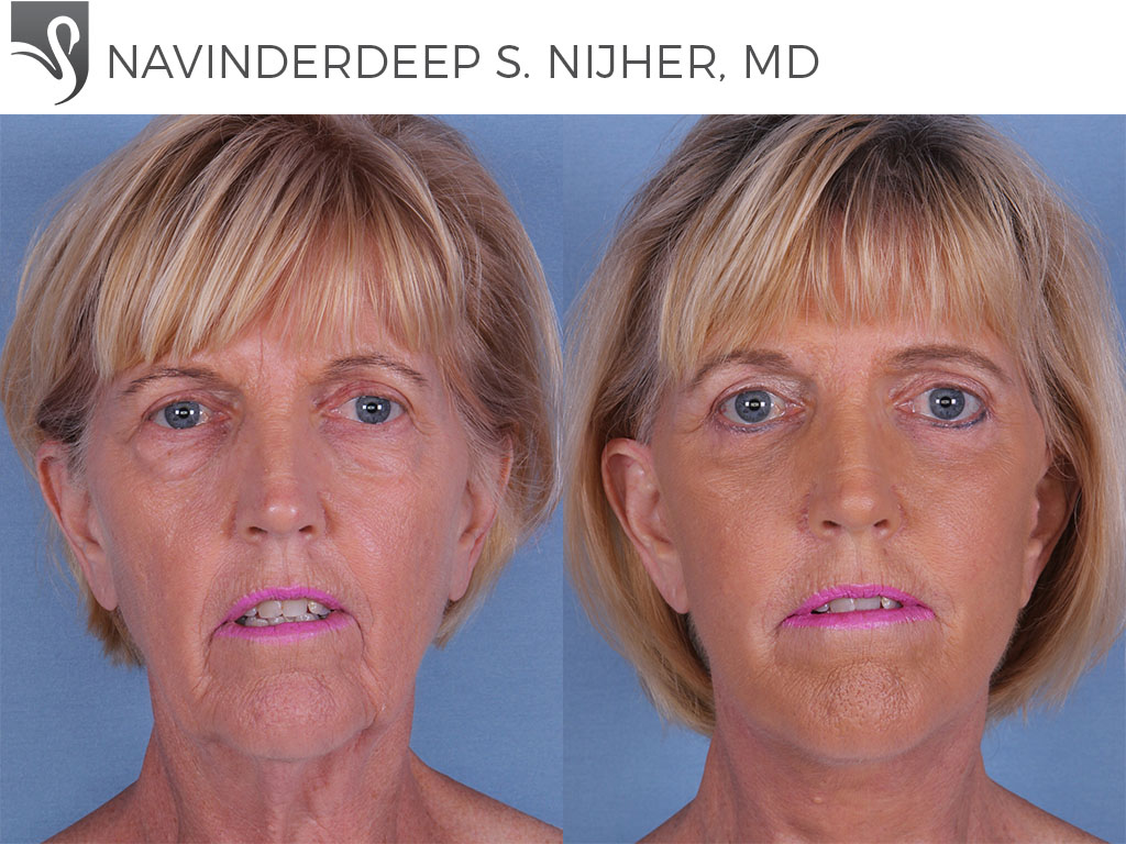 Before and After Image: Face Lift Case #13051 - front
