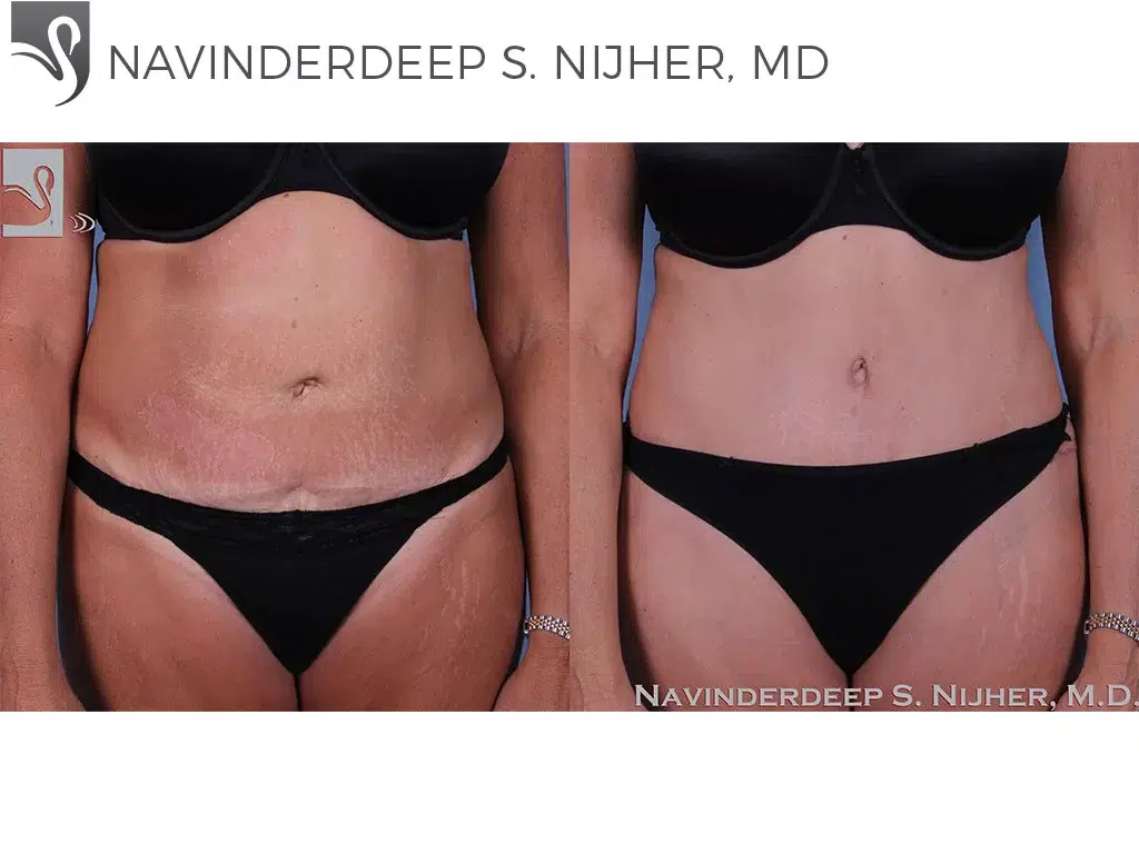 Before and After Image: Abdominoplasty (Tummy Tuck) Case #13942 - front
