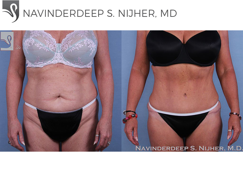 Before and After Image: Abdominoplasty (Tummy Tuck) Case #16935 - front