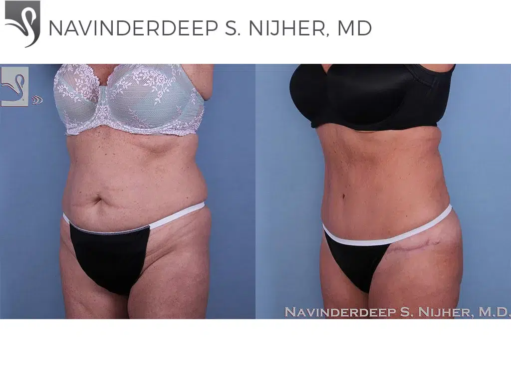 Before and After Image: Abdominoplasty (Tummy Tuck) Case #16935 - left-front-oblique