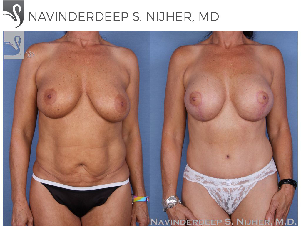 Before and After Image: Mommy Makeover Case #20729 - front