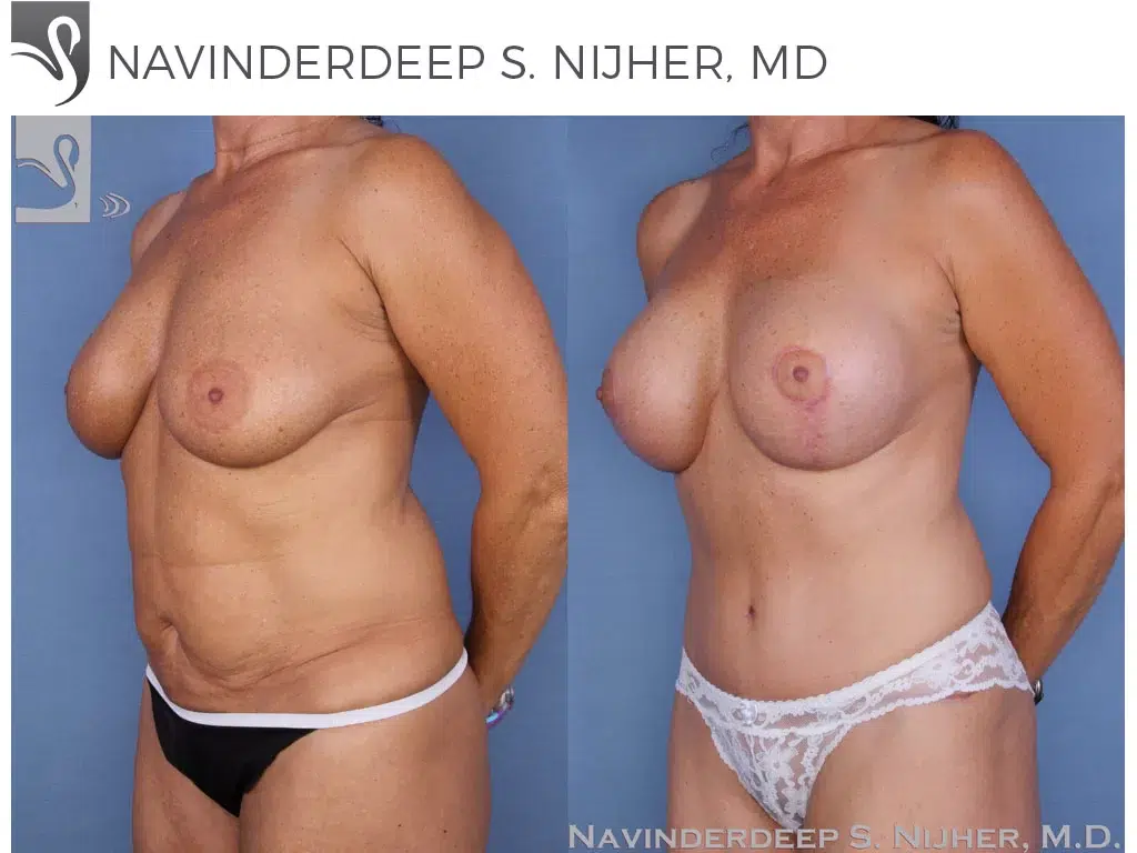 Before and After Image: Mommy Makeover Case #20729 - left-front-oblique