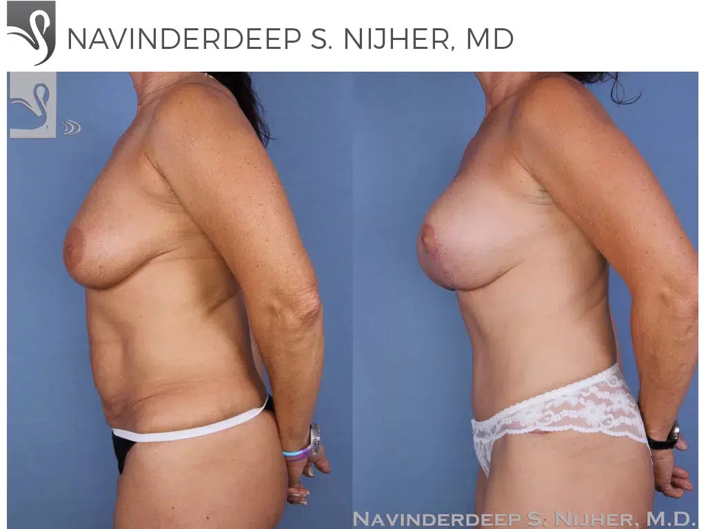 Before and After Image: Mommy Makeover Case #20729 - left-side