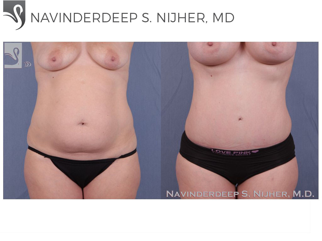 Before and After Image: Abdominoplasty (Tummy Tuck) Case #23428 - front