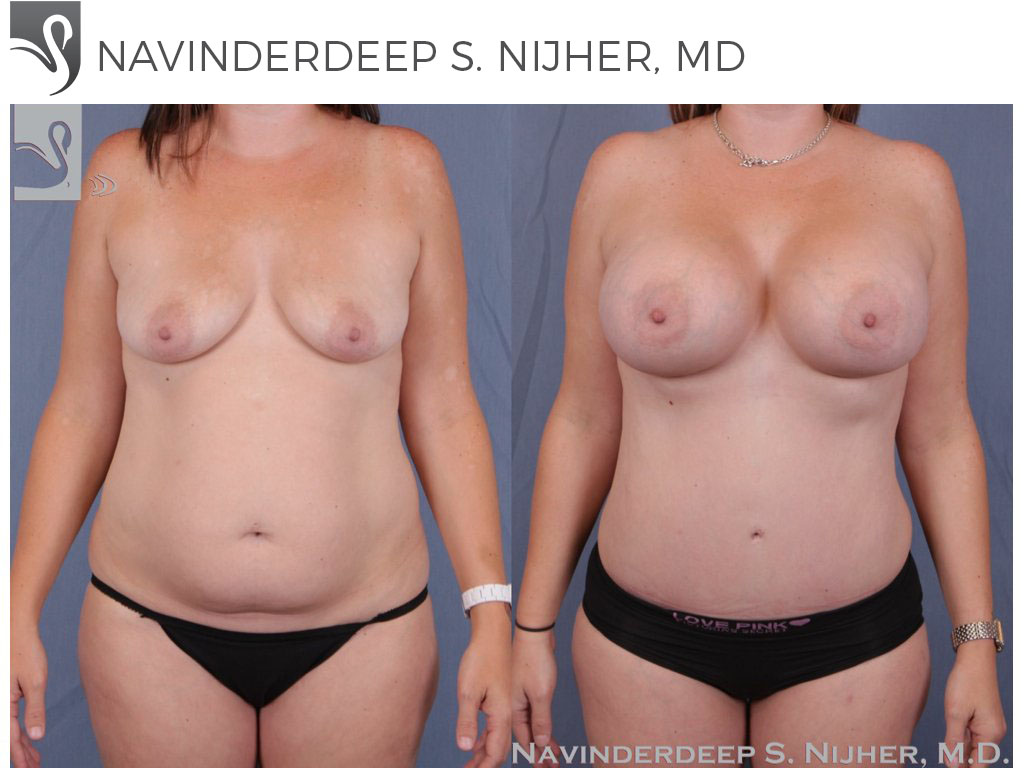 Before and After Image: Mommy Makeover Case #23428 - front