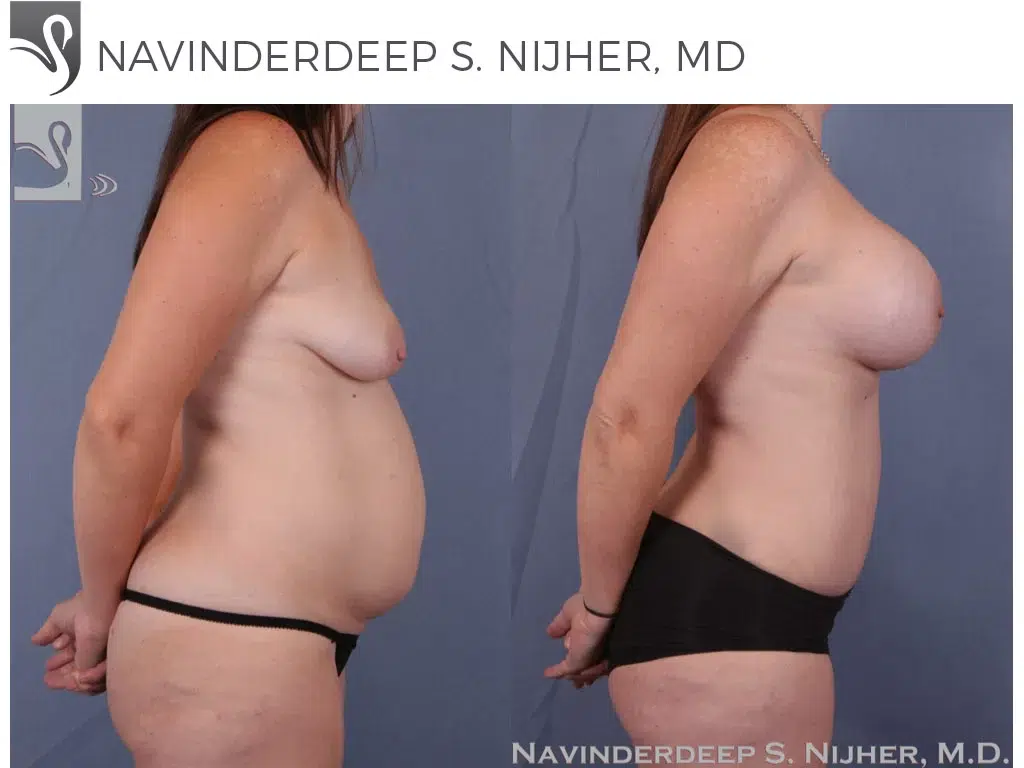 Before and After Image: Mommy Makeover Case #23428 - right-side