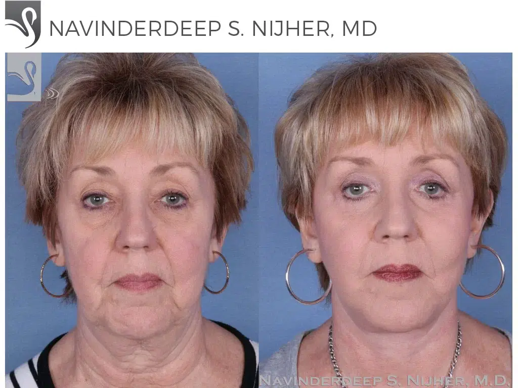 Before and After Image: Face Lift Case #24060 - front