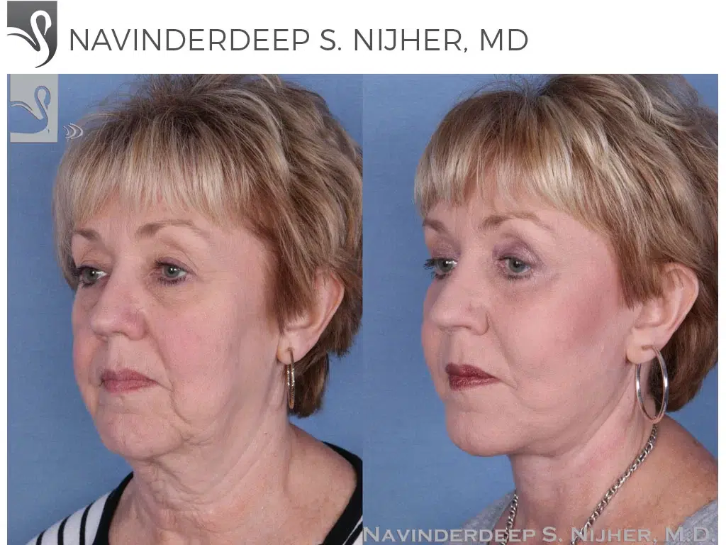 Before and After Image: Face Lift Case #24060 - left-front-oblique