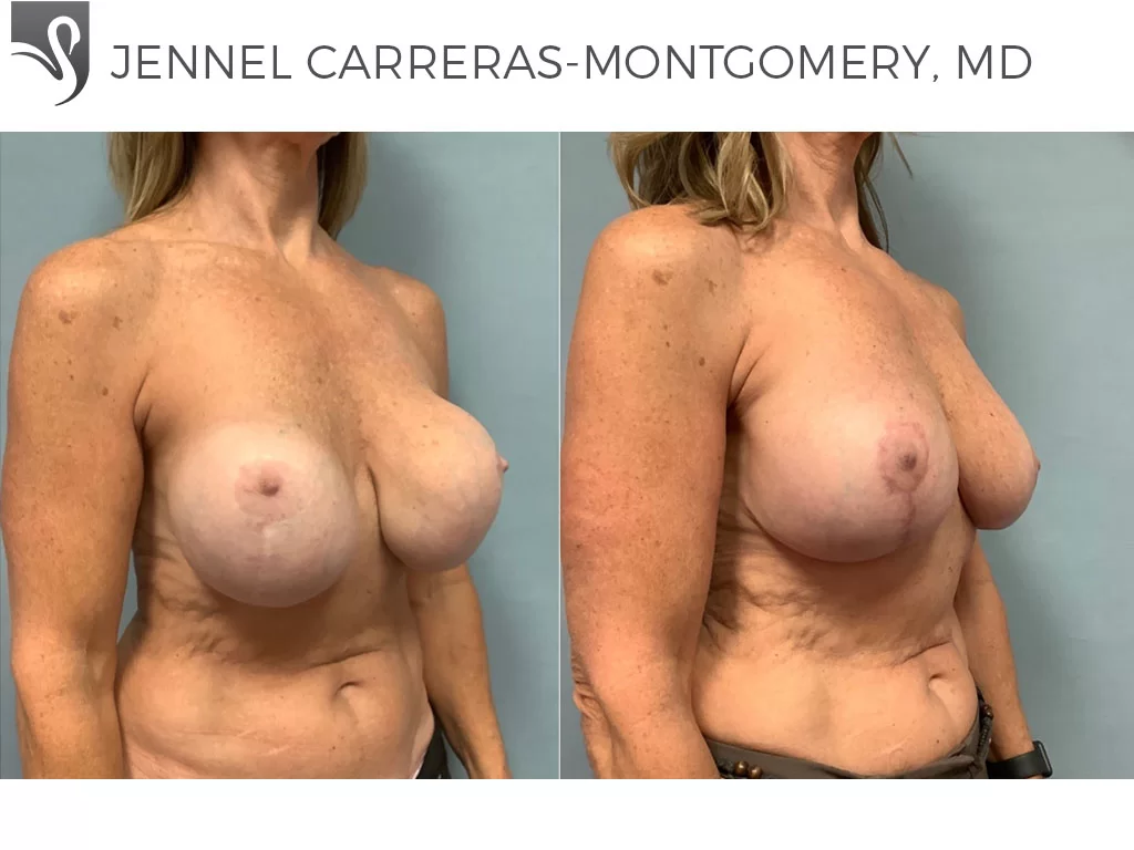Before and After Image: Breast Lift (Mastopexy) Case #24288 - right-front-oblique