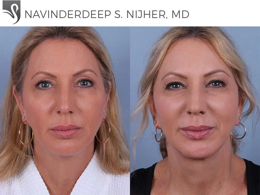 Before and After Image: Face Lift Case #24752 - front