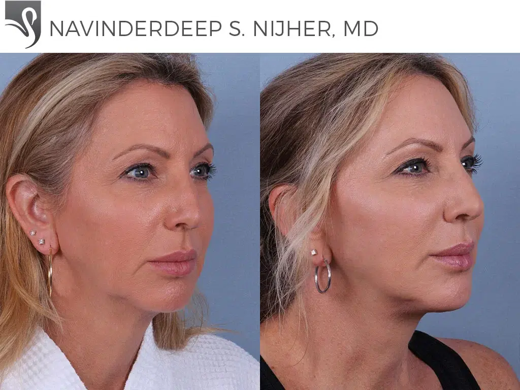 Before and After Image: Face Lift Case #24752 - right-front-oblique