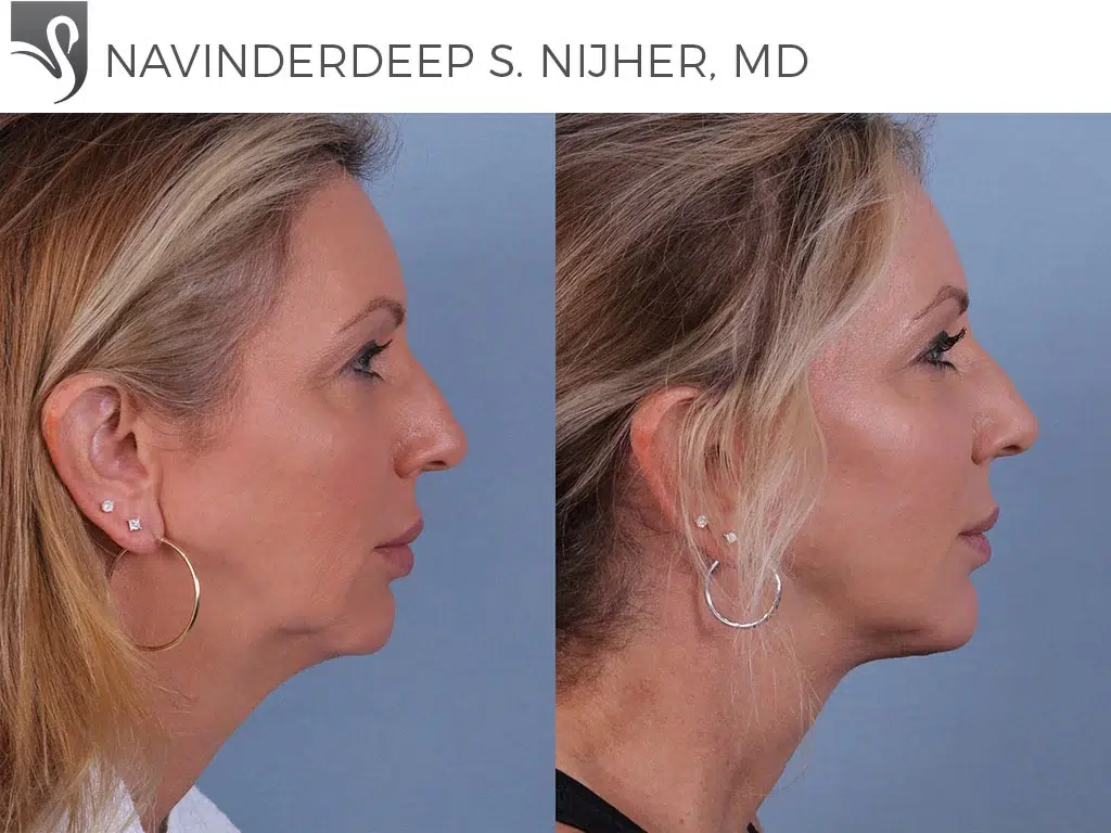 Before and After Image: Face Lift Case #24752 - right-side