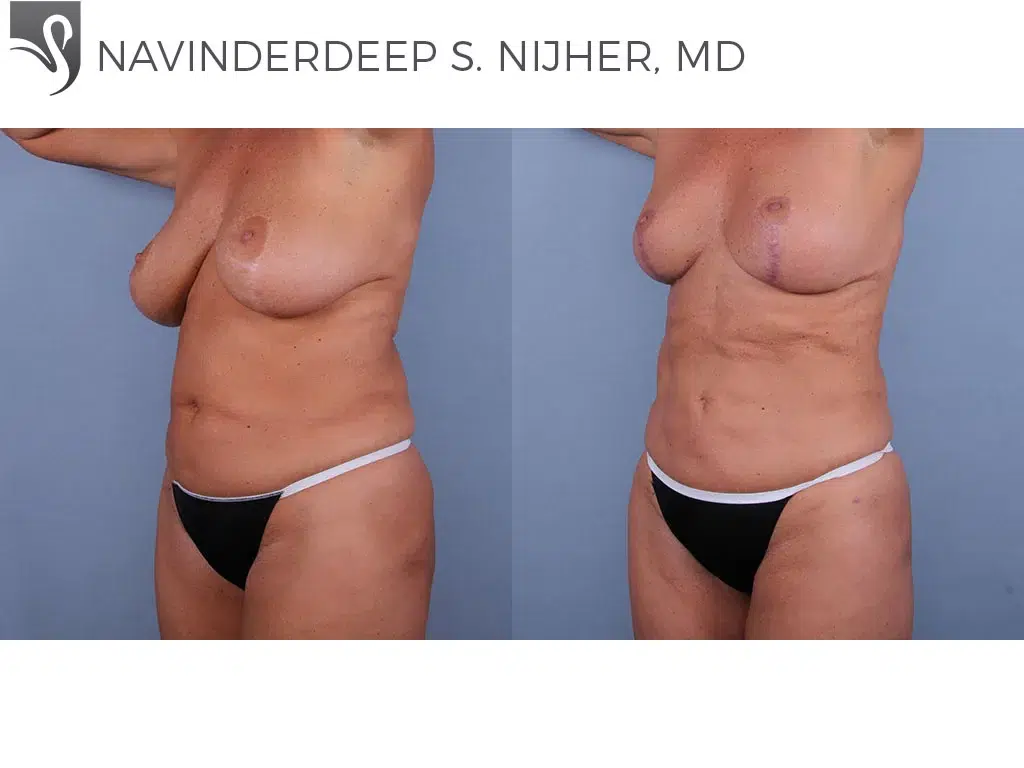 Before and After Image: Liposuction Case #25089 - left-front-oblique