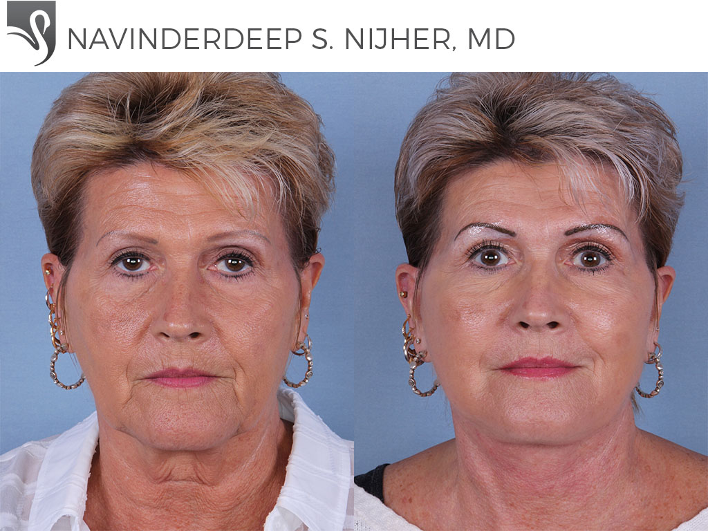 Before and After Image: Face Lift Case #25280 - front
