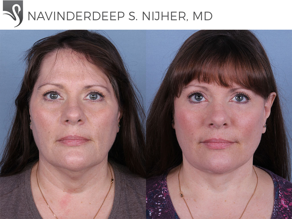 Before and After Image: Face Lift Case #26021 - front