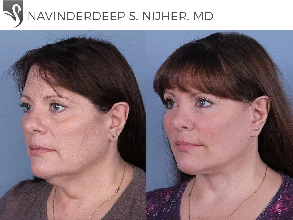 Before and After Image: Face Lift Case #26021 - left-front-oblique