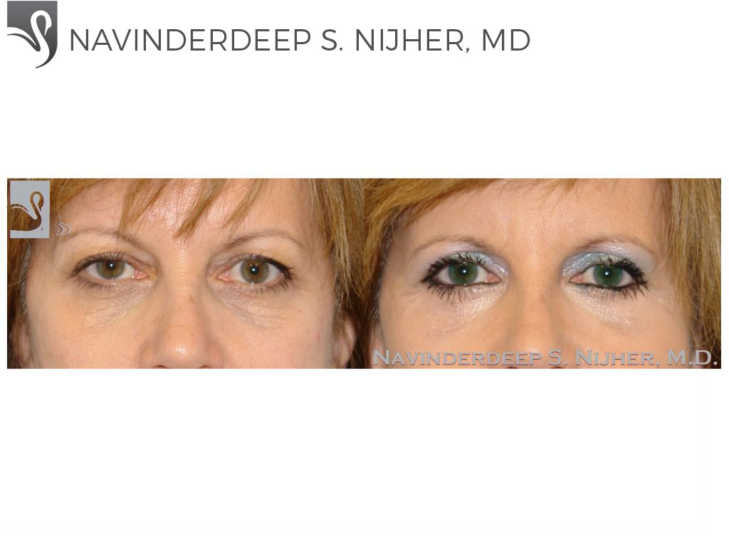 Before and After Image: Eyelid Surgery Case #26493 - front