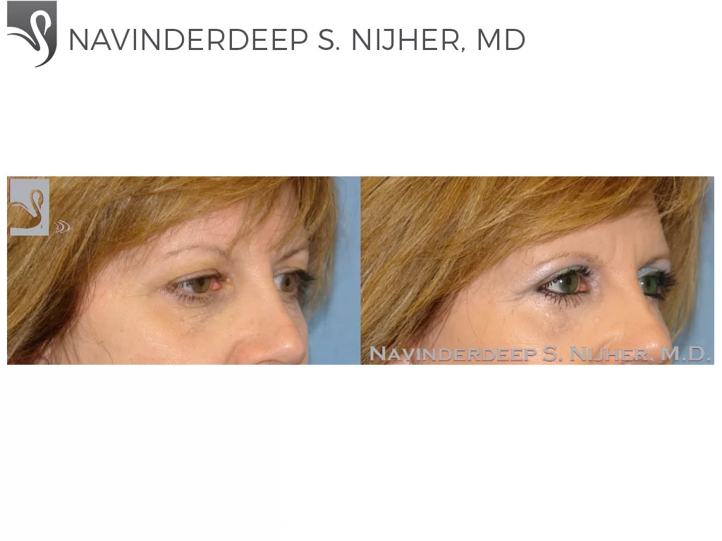 Before and After Image: Eyelid Surgery Case #26493 - right-front-oblique