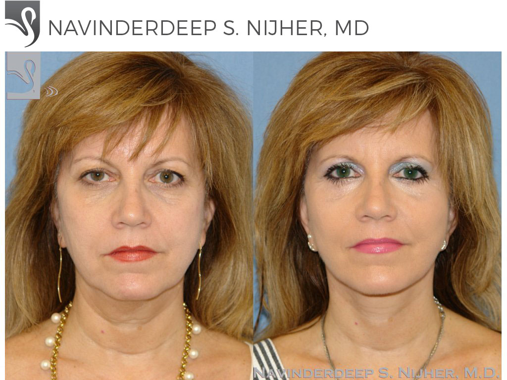 Before and After Image: Face Lift Case #26493 - front