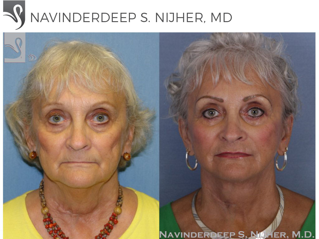 Before and After Image: Face Lift Case #26679 - front