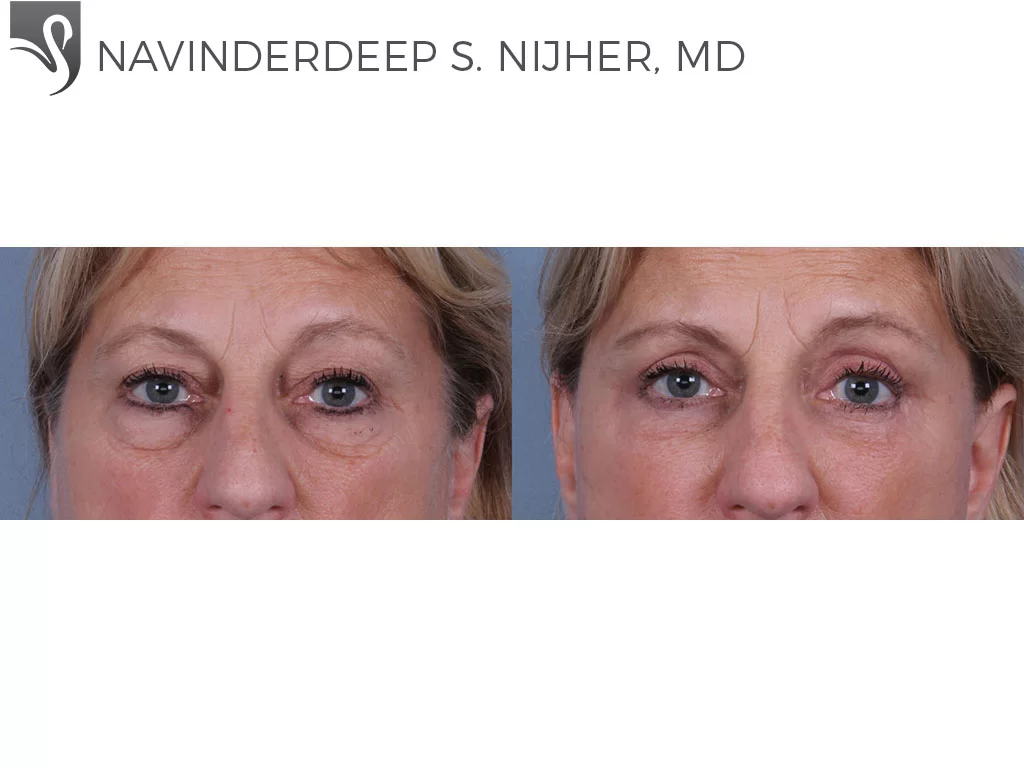 Before and After Image: Eyelid Surgery Case #30503