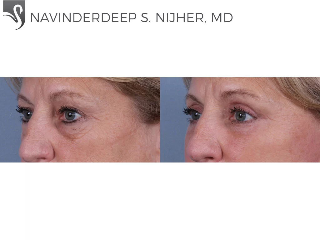 Before and After Image: Eyelid Surgery Case #30503 - left-front-oblique