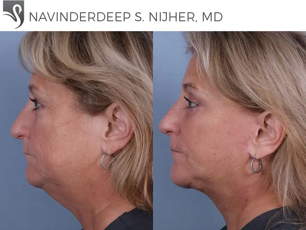 Before and After Image: Face Lift Case #30503 - left-side