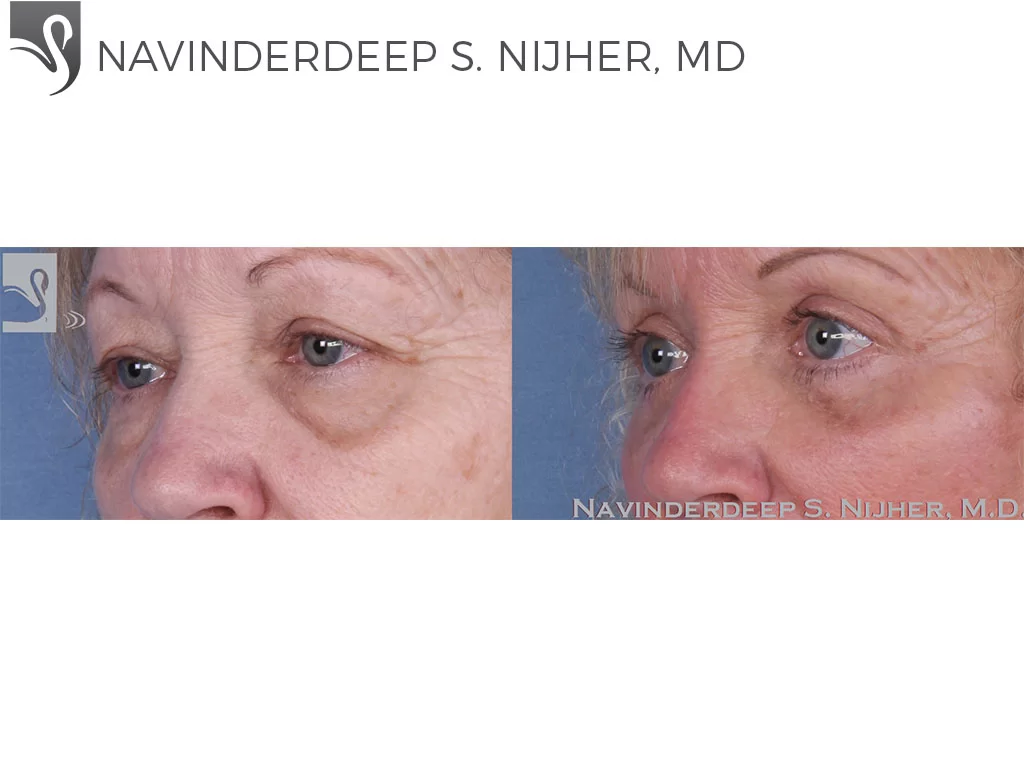Before and After Image: Eyelid Surgery Case #31789 - left-front-oblique