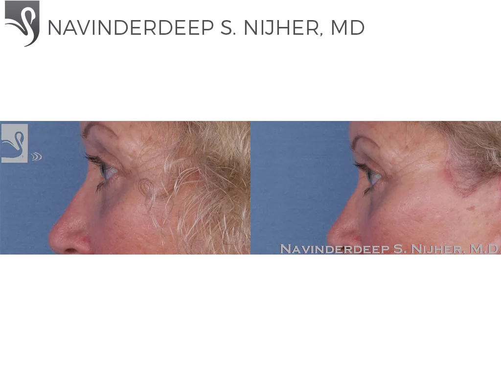 Before and After Image: Eyelid Surgery Case #31789 - left-side