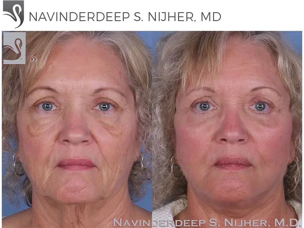 Before and After Image: Face Lift Case #31789 - front