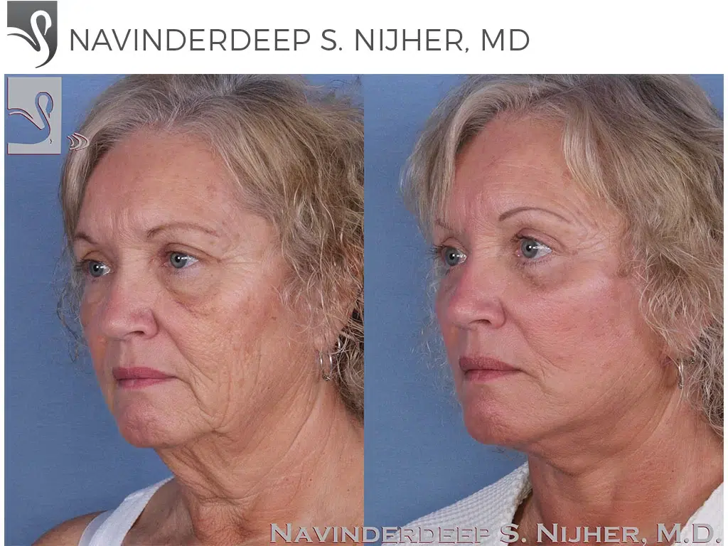 Before and After Image: Face Lift Case #31789 - left-front-oblique