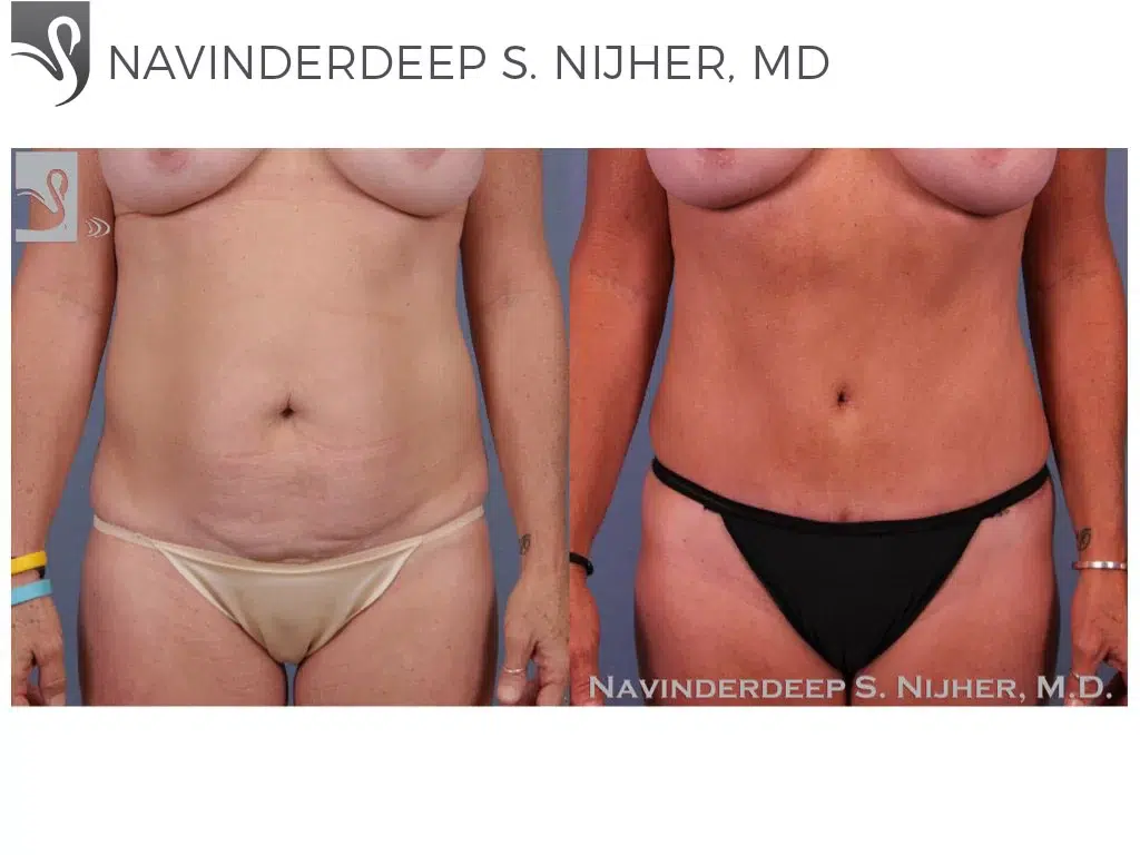 Before and After Image: Abdominoplasty (Tummy Tuck) Case #31990 - front