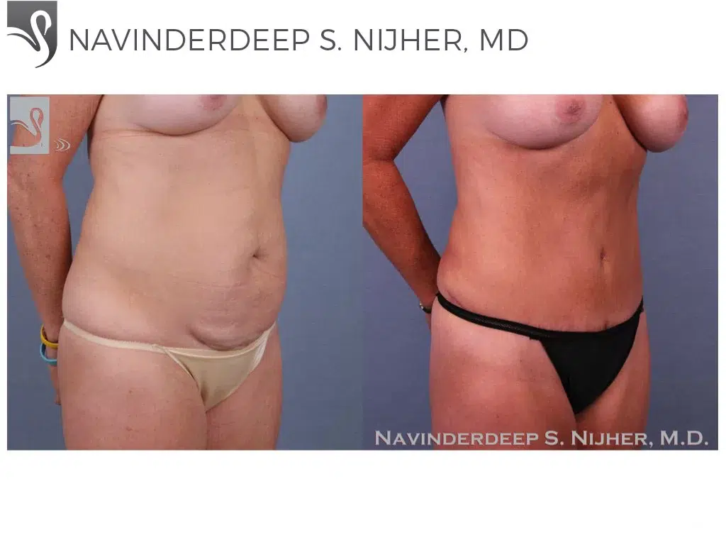 Before and After Image: Abdominoplasty (Tummy Tuck) Case #31990 - right-front-oblique