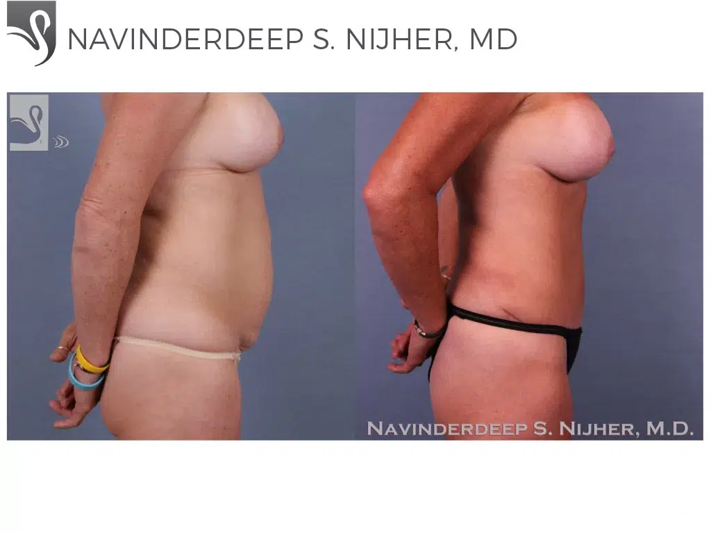 Before and After Image: Abdominoplasty (Tummy Tuck) Case #31990 - right-side