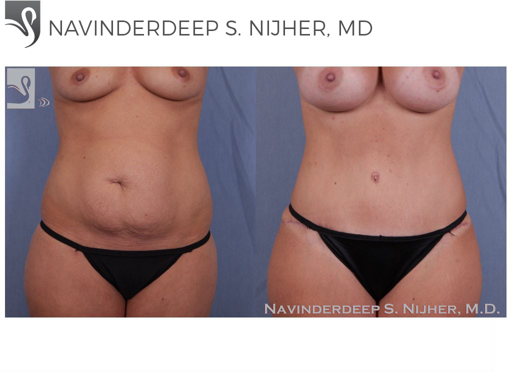 Before and After Image: Abdominoplasty (Tummy Tuck) Case #33055 - front