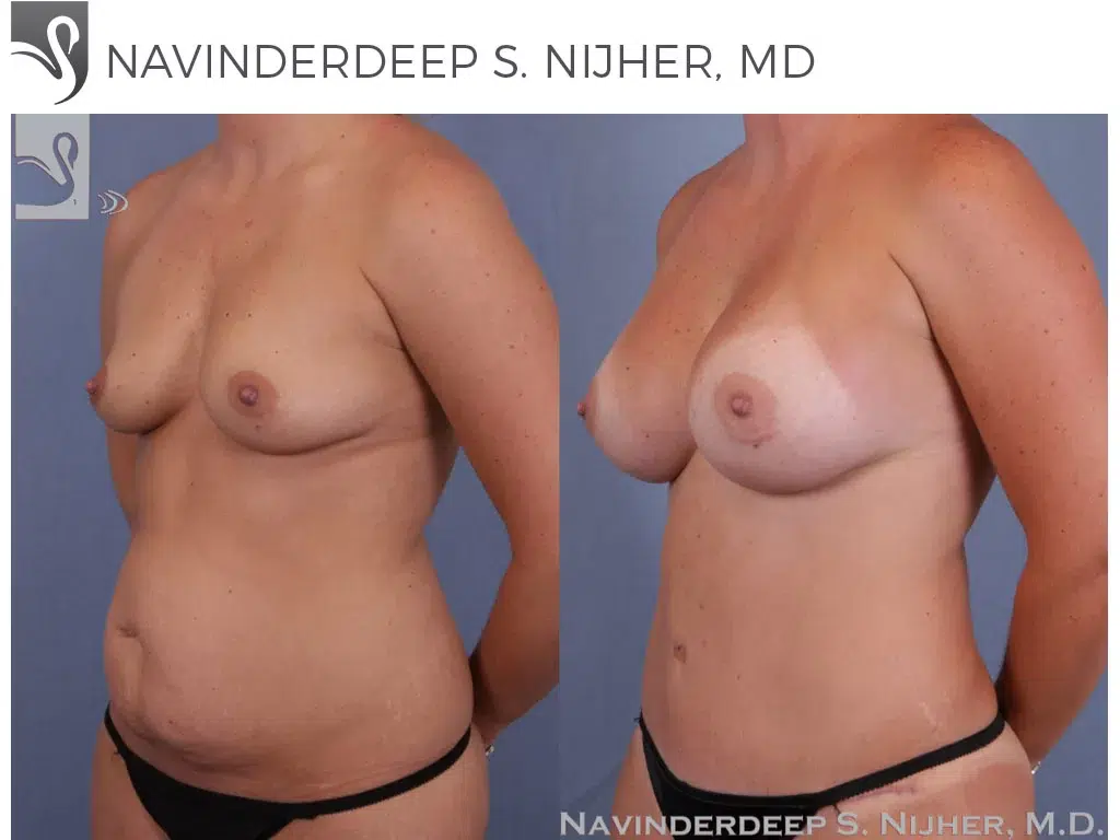Before and After Image: Mommy Makeover Case #33055 - left-front-oblique
