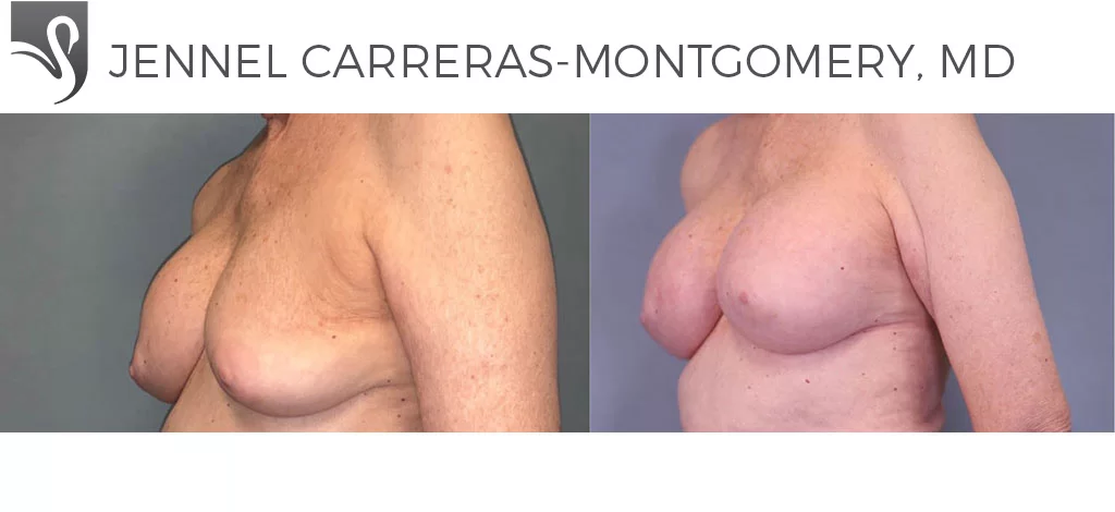 Before and After Image: Breast Revisions Case #33475 - left-front-oblique