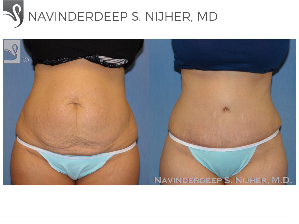 Before and After Image: Abdominoplasty (Tummy Tuck) Case #33536 - front