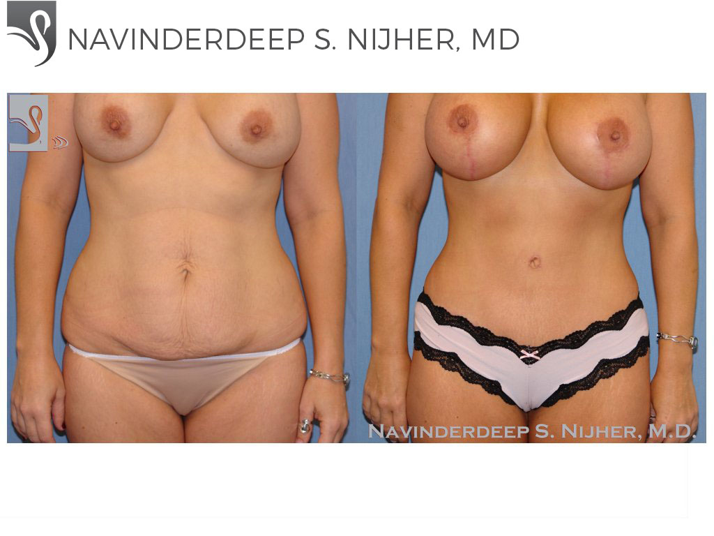 Before and After Image: Abdominoplasty (Tummy Tuck) Case #34573 - front