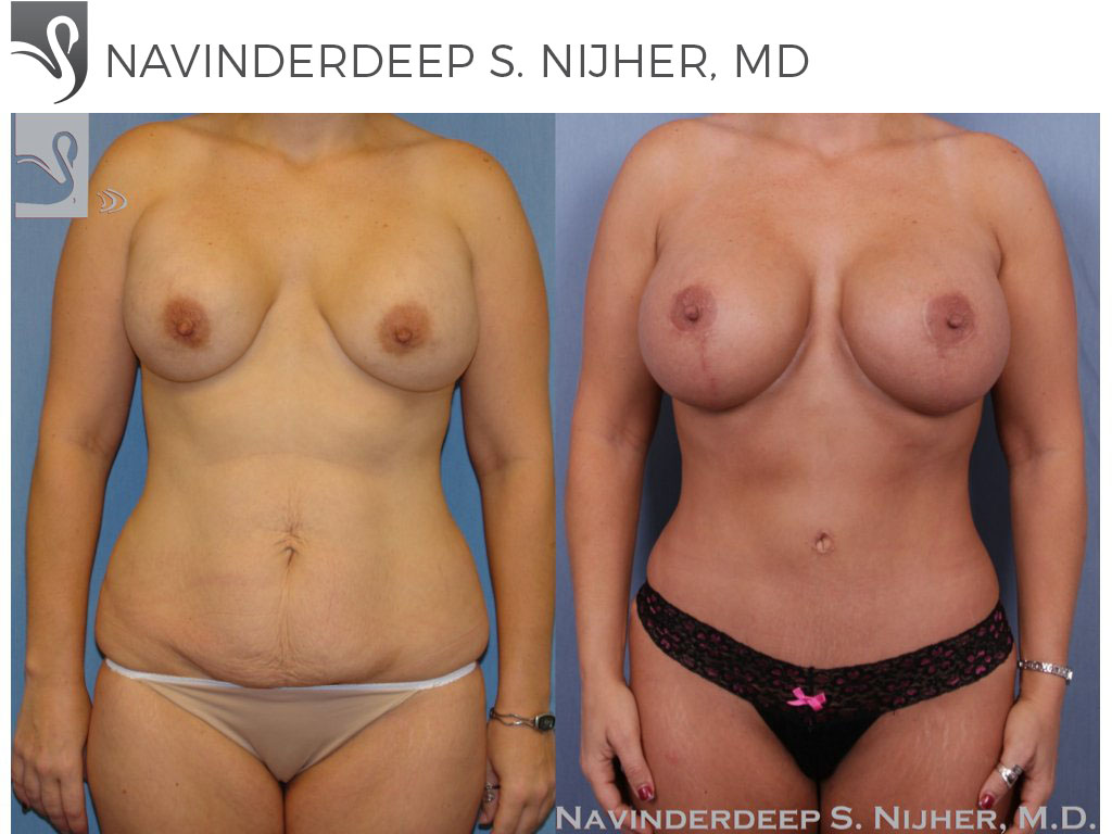 Before and After Image: Mommy Makeover Case #34573 - front