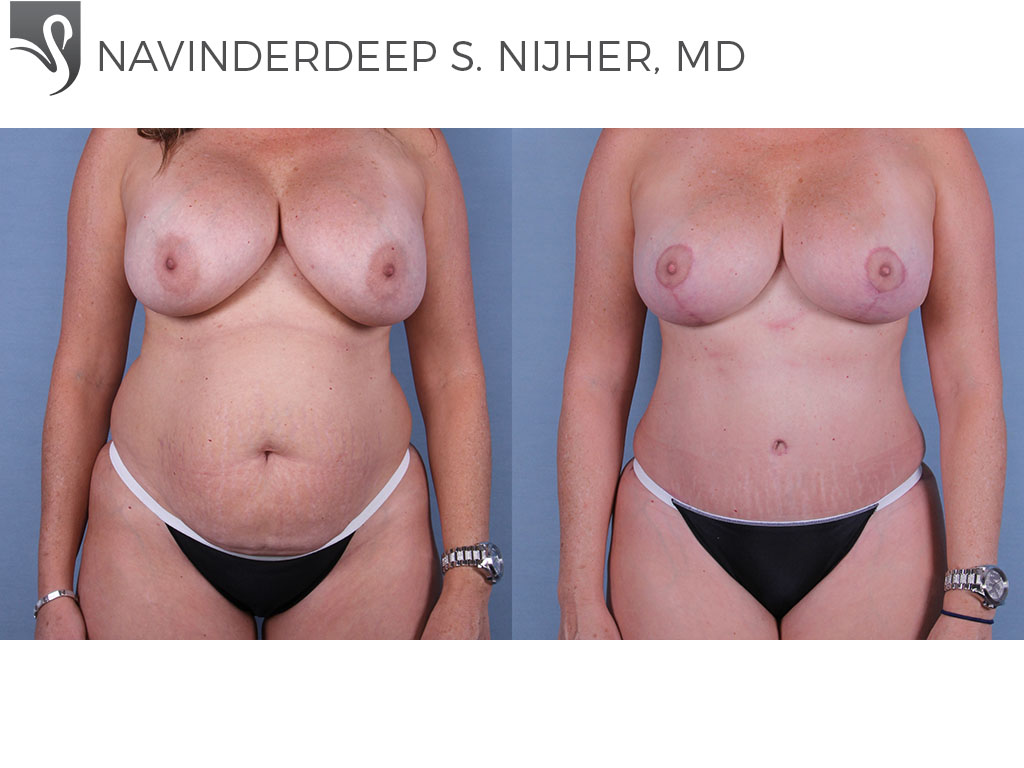 Before and After Image: Abdominoplasty (Tummy Tuck) Case #34715 - front