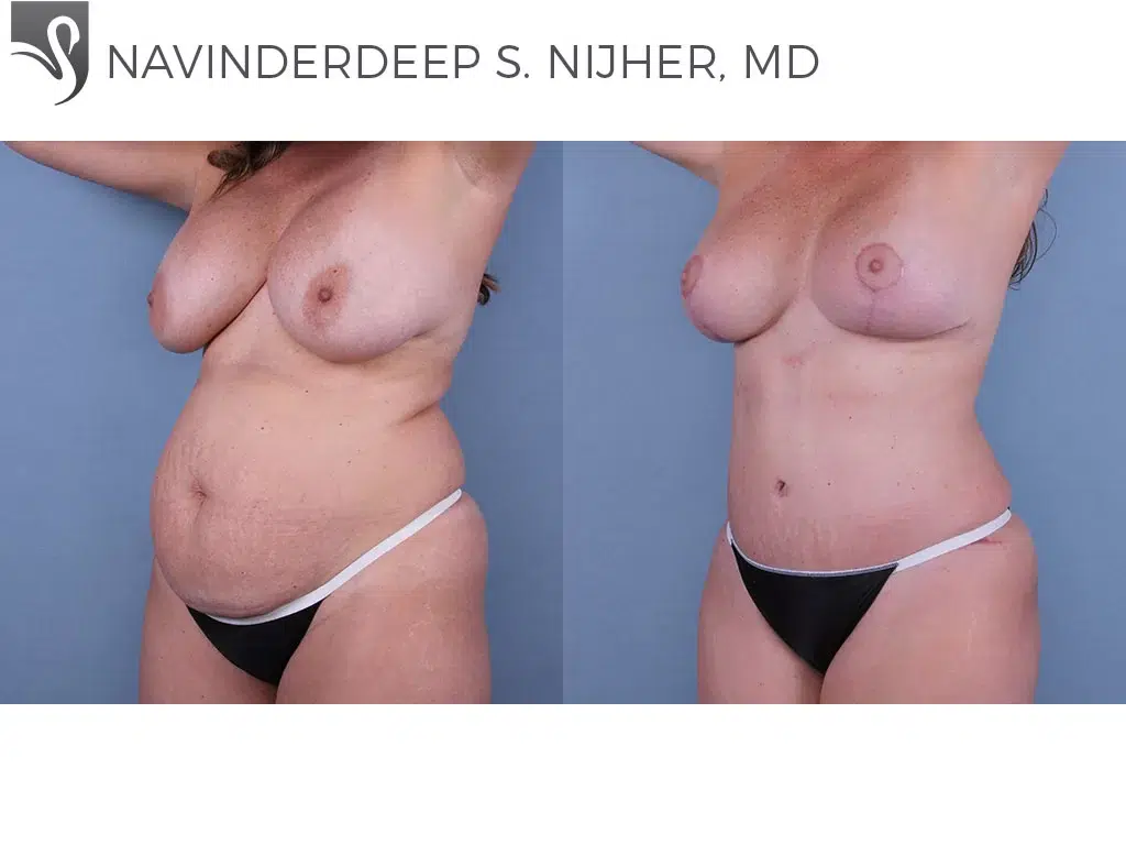 Before and After Image: Abdominoplasty (Tummy Tuck) Case #34715 - left-front-oblique