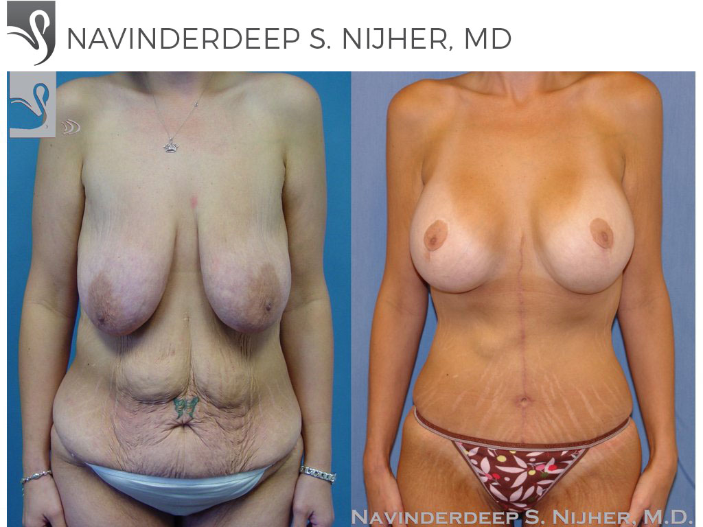 Before and After Image: Mommy Makeover Case #35196 - front