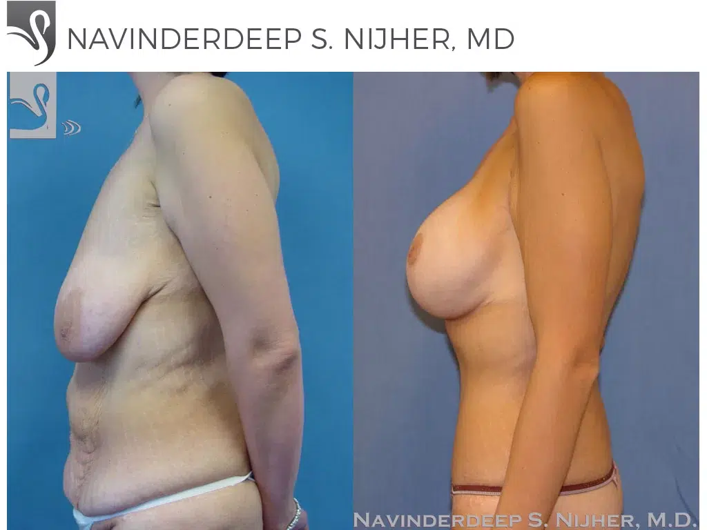 Before and After Image: Mommy Makeover Case #35196 - left-side
