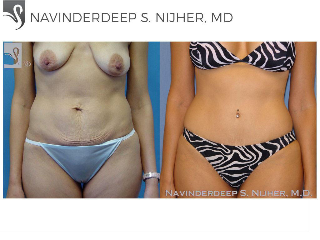 Before and After Image: Abdominoplasty (Tummy Tuck) Case #35264 - front