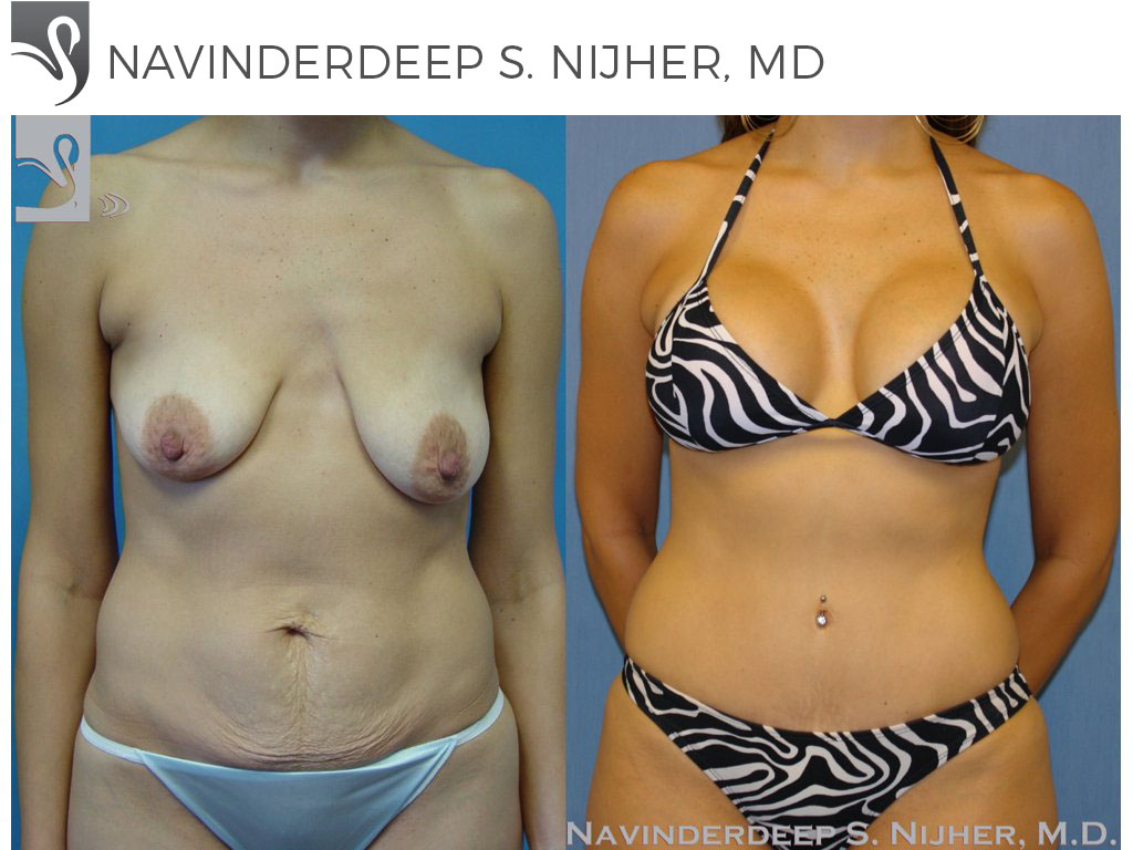 Before and After Image: Mommy Makeover Case #35264 - front