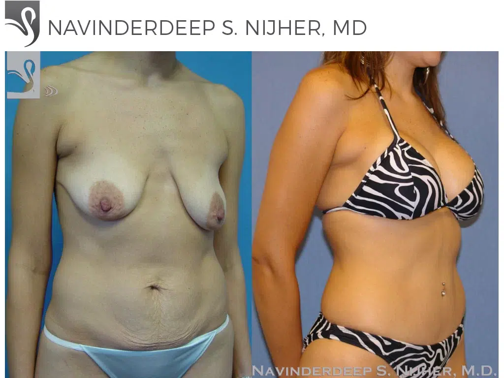 Before and After Image: Mommy Makeover Case #35264 - right-front-oblique
