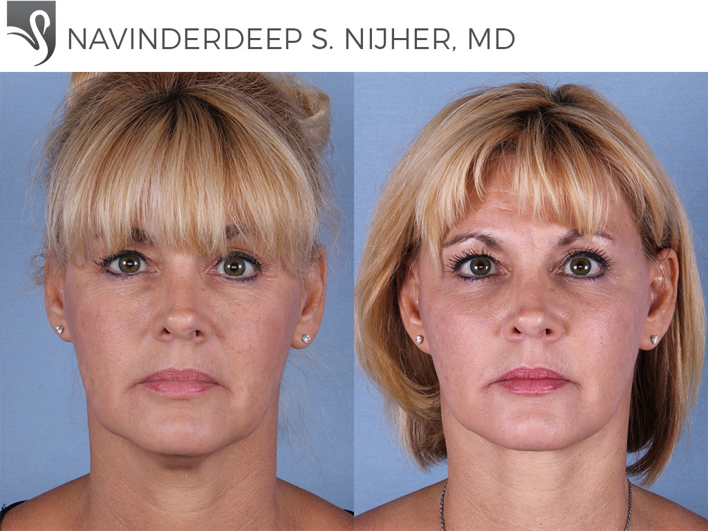 Before and After Image: Face Lift Case #36578 - front